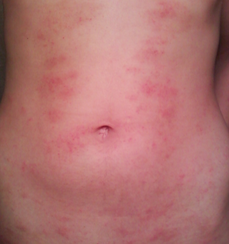 erupciones piel por alergias
