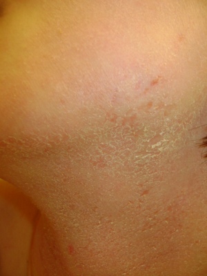 Topical steroid withdrawal red face