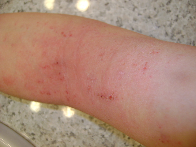 Rashes In Elbow Creases Pictures Photos