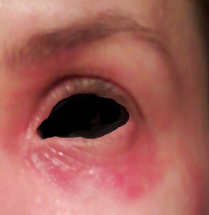 red rash around eye #10
