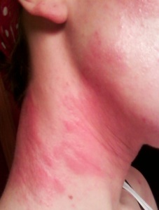 The neck rash that developed very soon after starting the candida diet, and stopping topical steroids.  It looks like two very large red angry hands wrapped themselves around my neck.