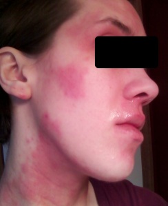 Same day as above, just a view of the other side of my face.  There's a very clearly outlined rashy patch on my cheek and you can still see my red, rashy neck in this picture.  I find it interesting how there will be portions of unaffected skin right next to red skin.