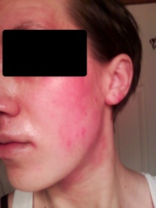 November 2012.  When I discovered I was allergic to aloe.  I had used pure aloe vera gel the night before on some spots on my limbs.  I woke up with my eyes almost puffed shut and my face scary inflamed and red almost all over my face and neck.  This picture does not do it justice.