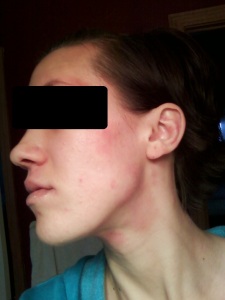 September 2012.  How things started.  I don't know if this was from TSW or using a product with aloe or what, but I had a few patchy rashes in specific places: around my eyes, on the side of my face, and on my neck (you can see the slight redness in this picture).  No huge deal, but it wouldn't go away.