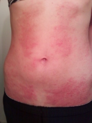 Previous picture of my stomach rash.