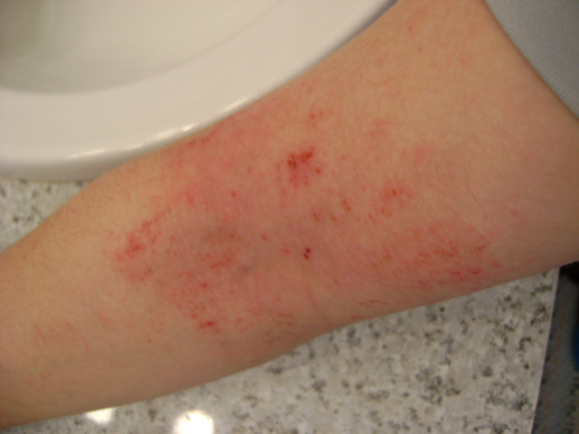 Rash in the crease of my arm...? | Yahoo Answers