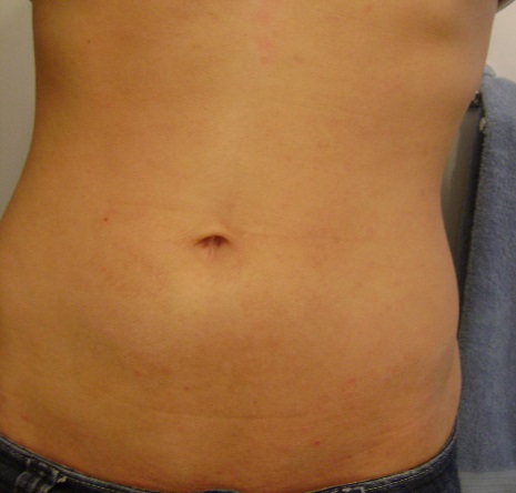 Steroid injection skin discoloration